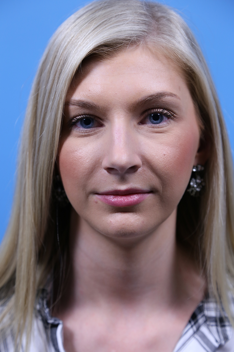 Rhinoplasty Before and After | Dr Evan W Beale