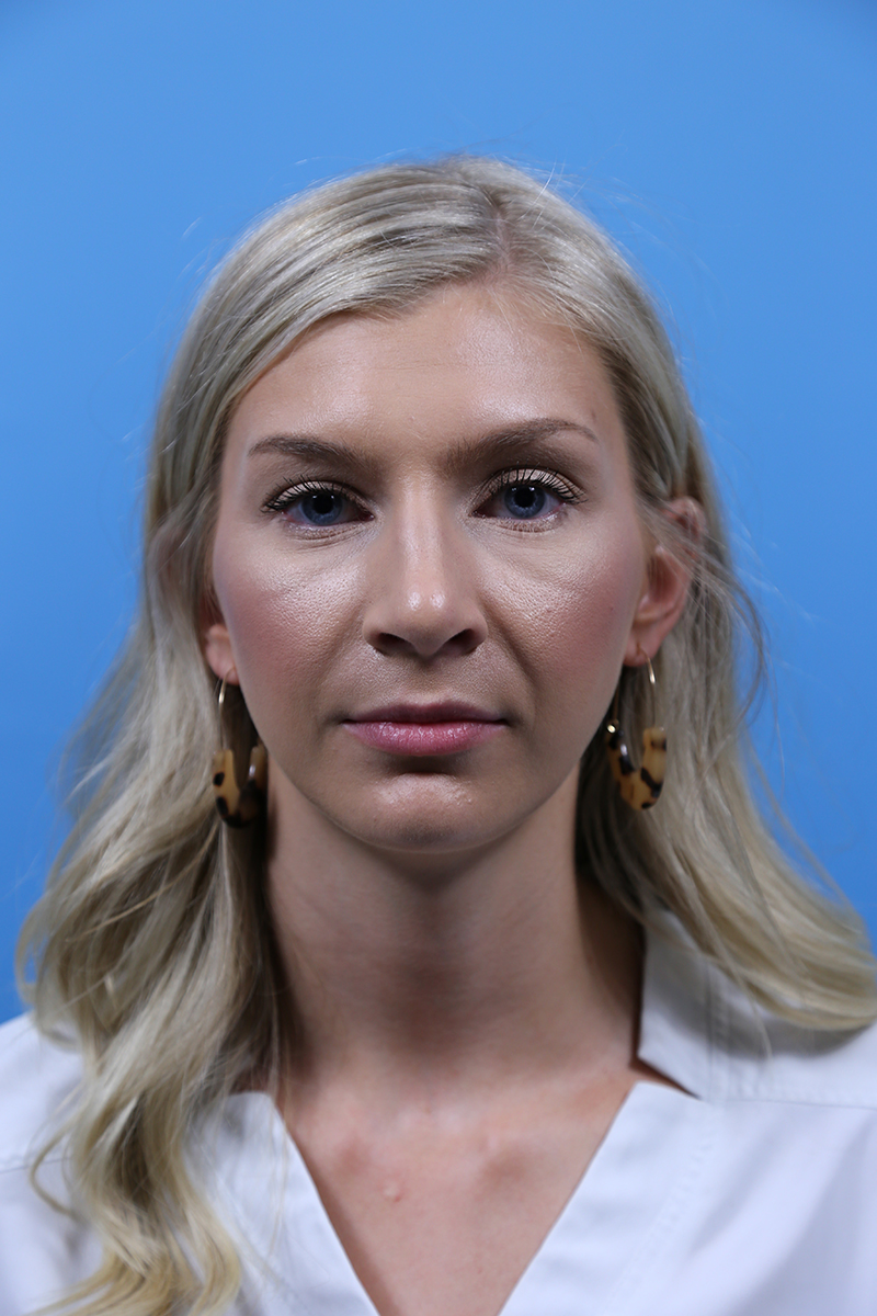 Rhinoplasty Before and After | Dr Evan W Beale