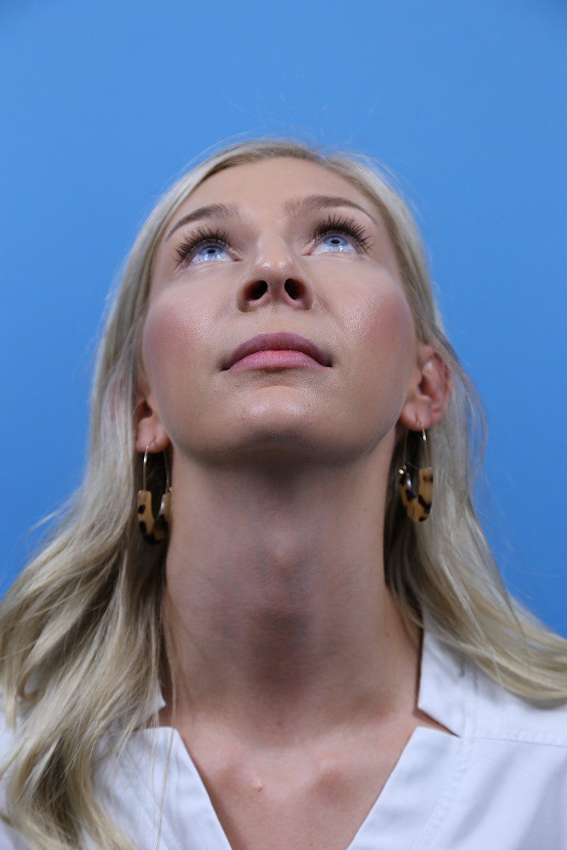 Rhinoplasty Before and After | Dr Evan W Beale