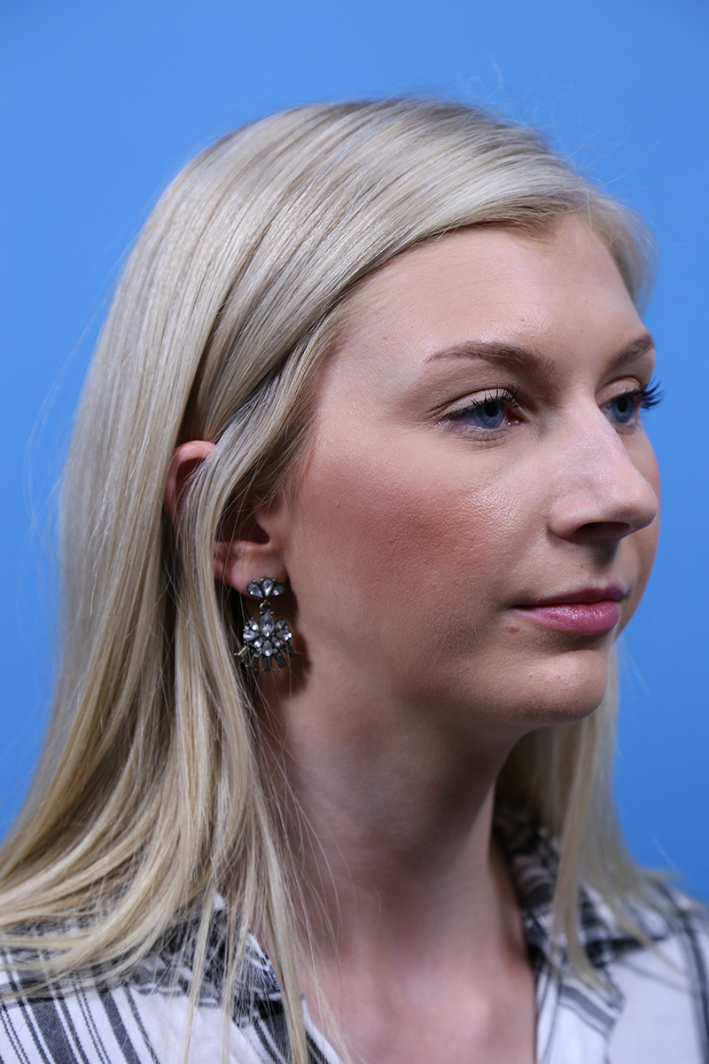 Rhinoplasty Before and After | Dr Evan W Beale