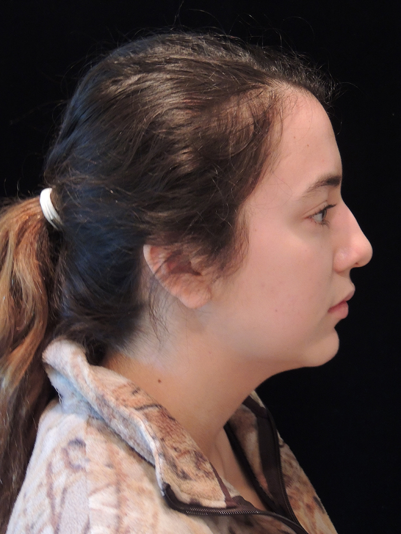 Rhinoplasty Before and After | Dr Evan W Beale