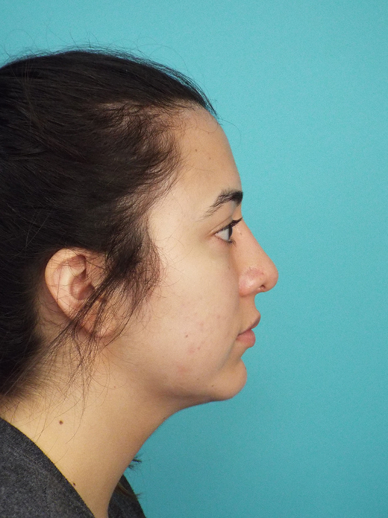 Rhinoplasty Before and After | Dr Evan W Beale